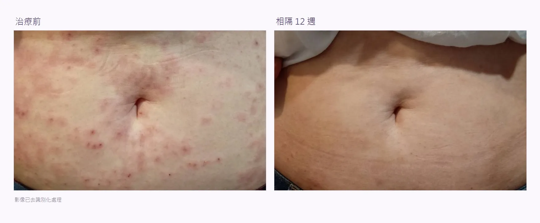 腹部皮膚治療前後對照：左為初診時，大量紅色丘疹與斑疹散布於腹部；右為相隔十二週後，皮膚平整、看不到明顯疹子