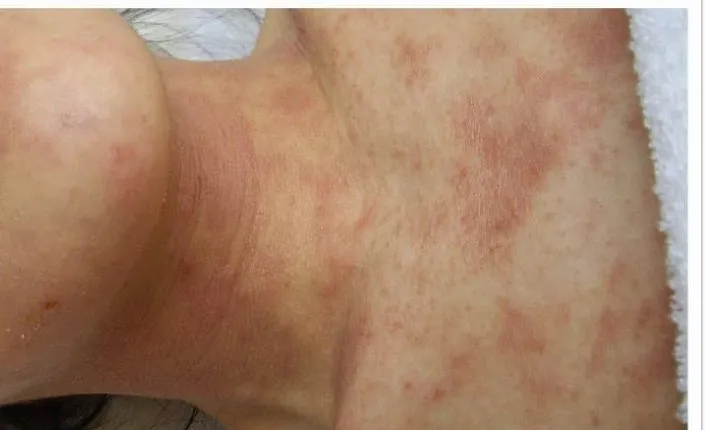 紅斑明顯減退,融合的大片紅轉為散在的紅色斑疹